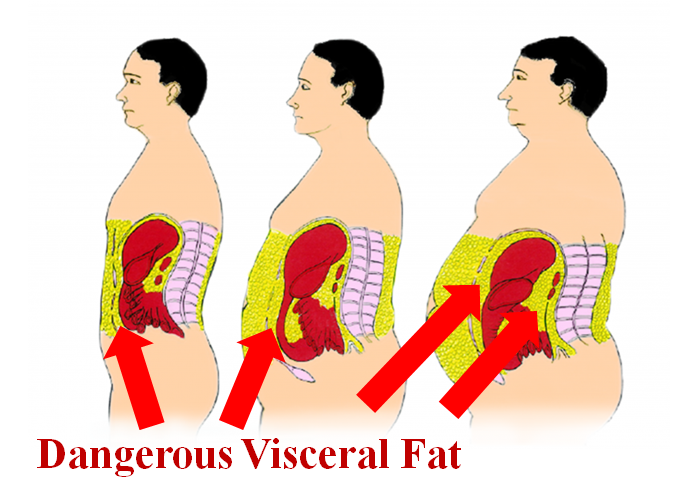 10 Horrible Diseases Caused By Carrying Too Much Visceral (Belly) Fat & How To Eliminate Your Risk